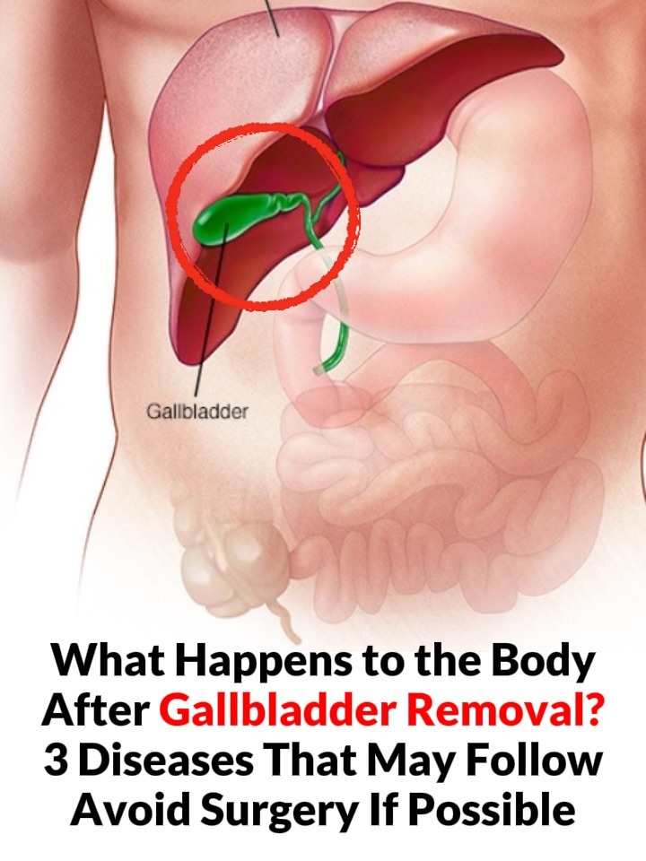What Happens to the Body After Gallbladder Removal? 3 Diseases That May Follow – Avoid Surgery If Possible