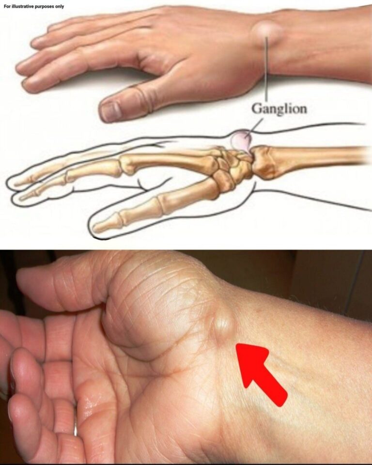 Noticing a Lump on Your Hand